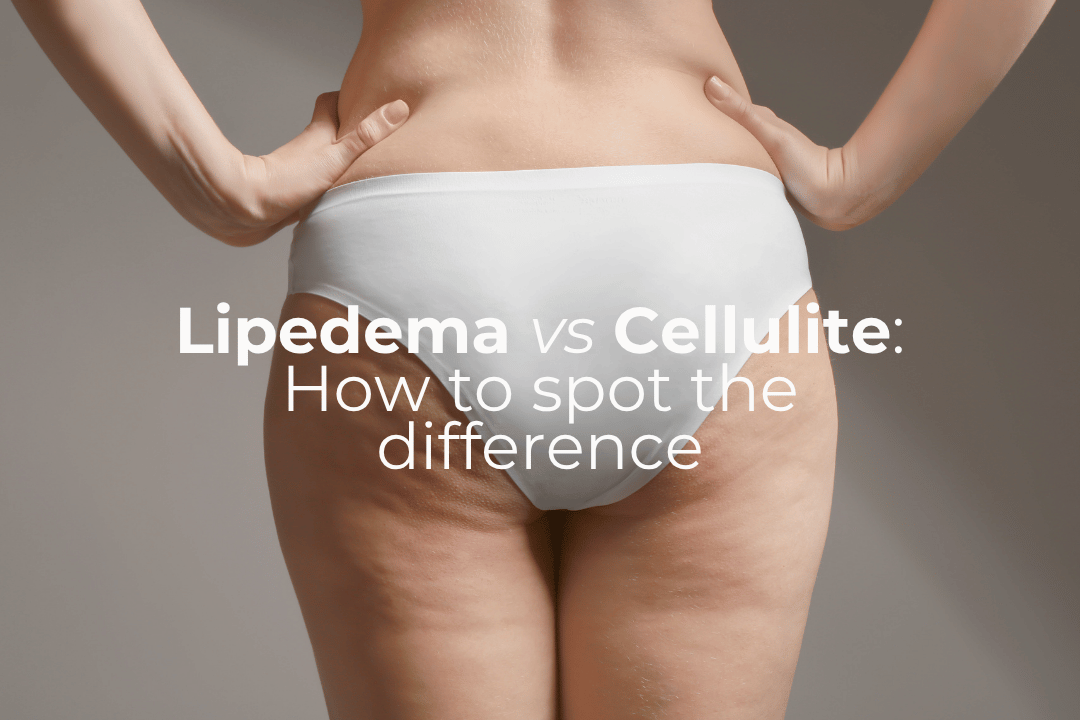 Lipedema vs Cellulite